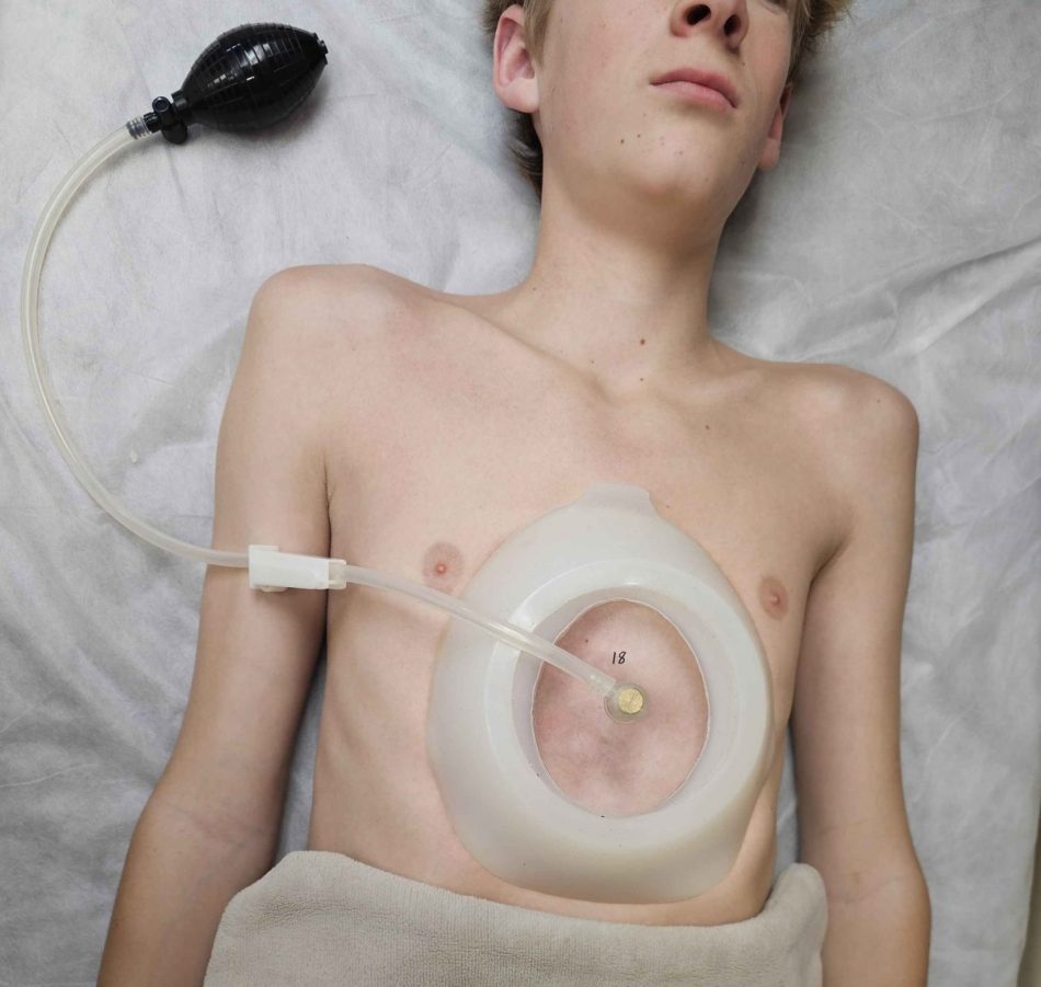 Vacuum Bell for Pectus Excavatum
